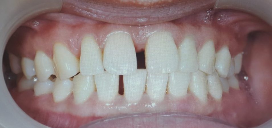 Orthodontics Before & After
