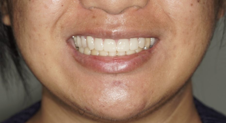 Dental Crown Before & After