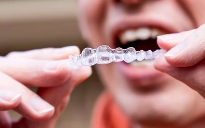 5 Common Myths About Invisible Braces (Clear Aligners)