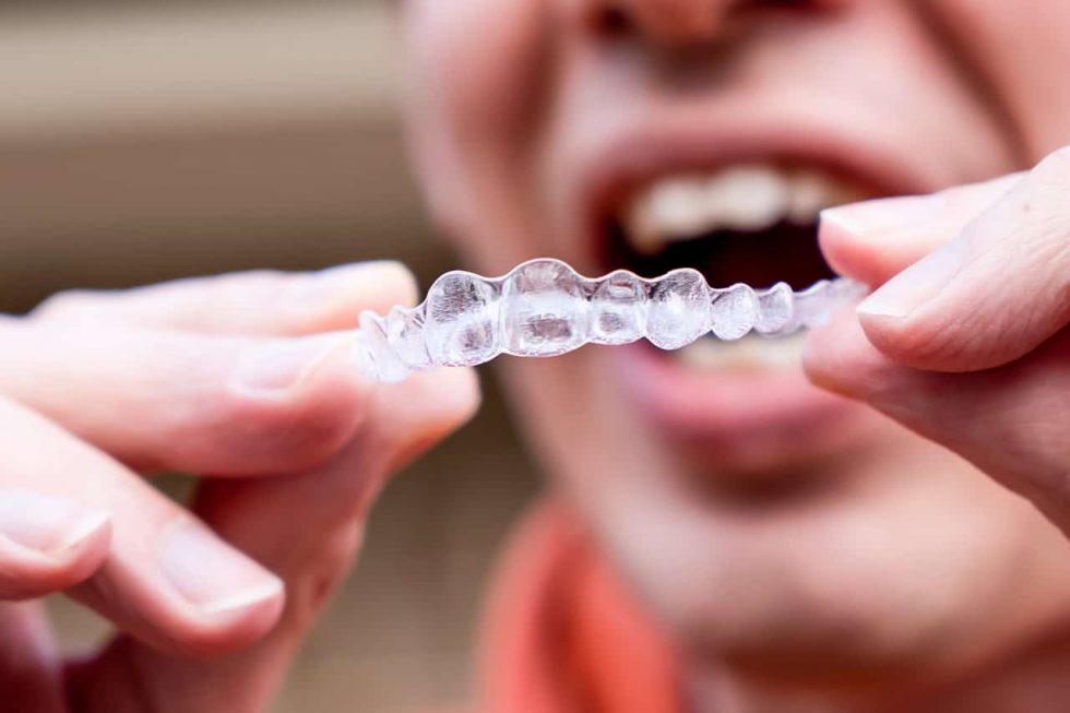 5 Common Myths About Invisible Braces Clear Aligners