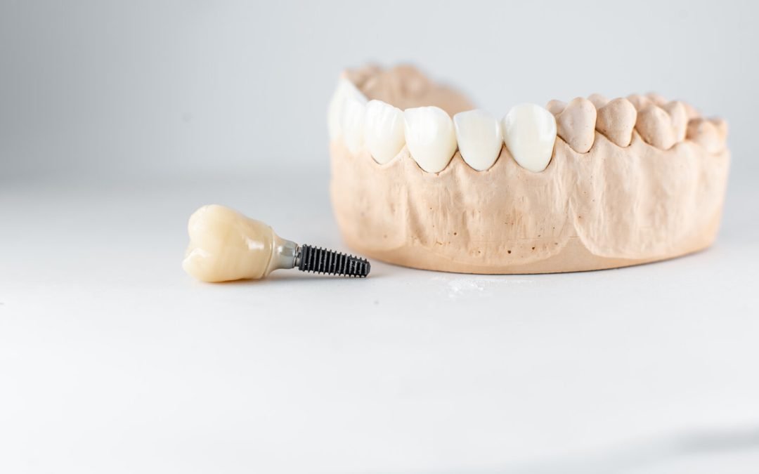 Six Dental Implant Myths, Debunked!